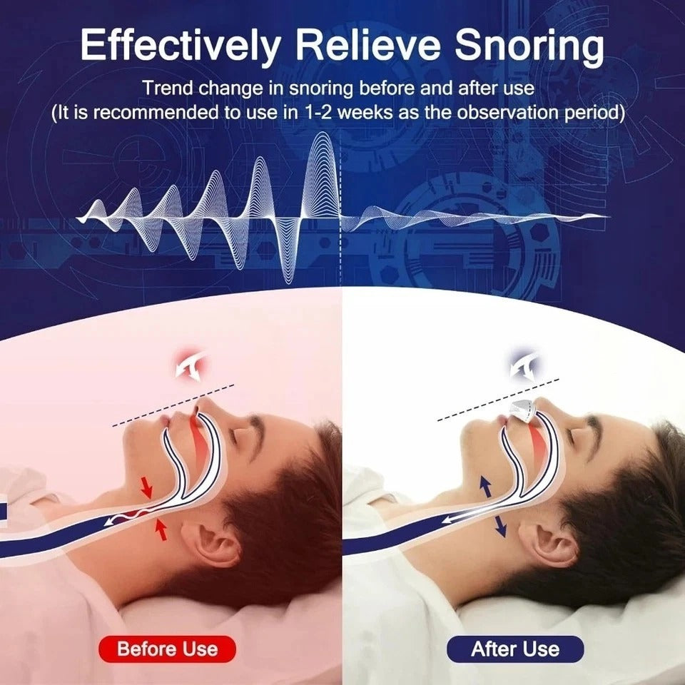 Anti Snoring Device, Sleep Apnea Stopper, Electric Snore Relief, Micro Sleep Aid